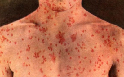 Measles020218.jpg